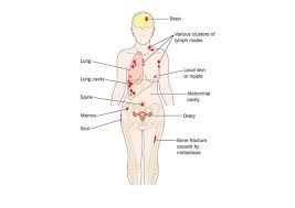 Finding out that you have a incurable disease like stage iv metastatic breast cancer can be completely overwhelming and fill your mind with a thousand questions. Initial Surgery And Survival In Metastatic Breast Cancer Breast360 Org The American Society Of Breast Surgeons Foundation