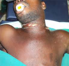 Emorandum requesting duplicate keys : Facial Cellulitis Of Dental Origin Experiments From The University Of Bouake Health Centre Cote D Ivoire
