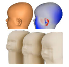 Bebek doğum kanalında ilerlerken, başı önde olduğu için basınca en çok maruz kalan yer kafasıdır. Ebeveyn Klavuzu Cranial Tedavi Merkezi