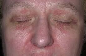 Seboreik Dermatit Tedavisi Tedaviler Gen Tr