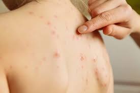 Image result for Skin Infection