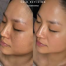 JERRY SHIPMAN SKIN REVISION