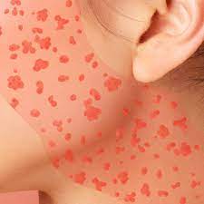 Treatment for sun poisoning rash will depend on the type of poisoning and the intensity of burning. How To Care For Your Angry Skin After An Allergic Reaction On Your Face Self