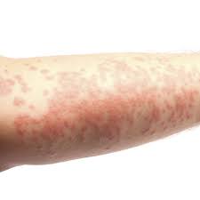 We did not find results for: Rash And Inflammation While On Lamictal