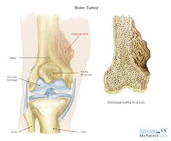 Image result for Osteosarcoma