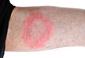 Woran Eine Borreliose Zu Erkennen Ist Gesundheitsstadt Berlin