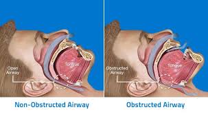 Image result for Sleep Apnea