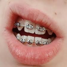 Braces Life Braces Pastel Pink Grey Ugh Pink Braces Cute Braces Braces Colors