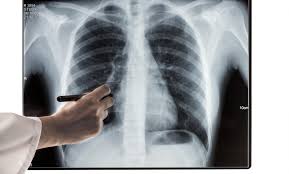 The second intercostal space, under the third rib. Costochondritis Causes Symptoms And Treatment