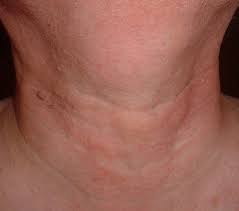 Anatomically, the throat is the muscular tube that runs initial symptoms of throat cancer. Throat Cancer Symptoms Complications And Treatment
