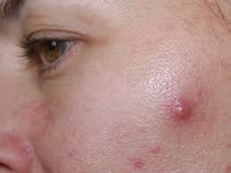 Clinical experience suggests the utility of mupirocin (intranasal ointment) in the treatment of nasal vestibulitis bhattacharyya 2020, wang 2020. Accutane Side Effects You Might Not Expect