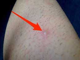 Here's why ingrown hairs form and how you can get rid of and prevent them for good. How To Prevent Ingrown Hairs
