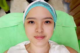 Berbagai bentuk jerawat dapat terjadi akibat folikel rambut di bawah kulit penyebab jerawat tidak diketahui secara pasti. Review Treatment Photo Facial Acne Di Zap Clinic Sprinkle Of Rain