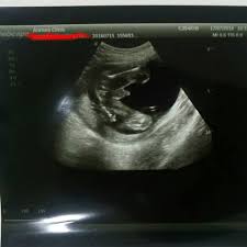 30+ gambar scan bayi perempuan, gaya terbaru! Doktor Boleh Tahu Tak Annura Clinic Medical Surgery ÙÙŠØ³Ø¨ÙˆÙƒ