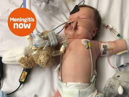 Meningitis treatment depends on the severity and cause of the illness. Meningitis Treatment Meningitis Now