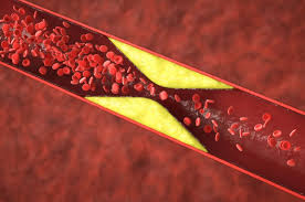 Por qué se tapan las arterias del corazón? Causas y signos