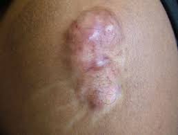 Pathomechanisms and current and emerging treatment strategies. Keloid And Hypertrophic Scar Dermnet Nz