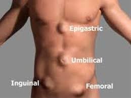 Hernia Abdominal Dr Silvio Ikoma Endoscopia Digestiva