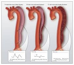 Partial Thrombosis Of The False Lumen In Patients With Acute Type B Aortic Dissection Nejm What can cerebral aneurysm, thrombosis, or hemorrage be the cause of? answered by dr.