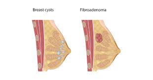 Sharp pain in one breast. If It S Not Breast Cancer What Else Could It Be Coordinated Health Orthopedics