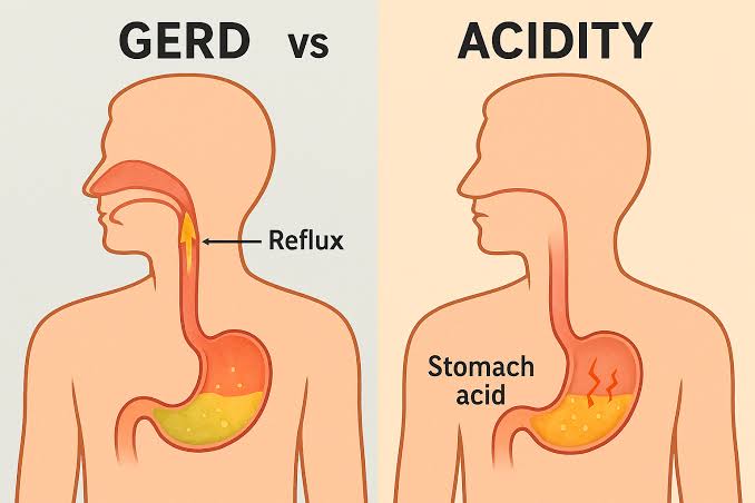 Acid Reflux