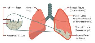 Identifying stages is a system developed by doctors to evaluate the progression of a disease. Diagnosis Of Mesothelioma Lust With Life Health Tips Beauty Hacks Medicine Medical Question Bank Mbbs Md Questions