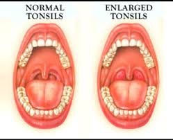 Tonsillitis Causes Symptoms Diagnosis