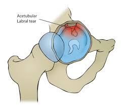 Image result for Hip Labral Tear