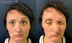A gold eyelid weight procedure is performed at an outpatient treatment center. Reconstruction Of Eye Closure Through Implants Fazialis