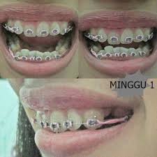 Motif ini berbentuk seperti rantai karena karet yang menjadi satu rangkaian dan tidak terpisah. Pakai Behel Kawat Gigi Yay Or Nay