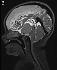 Check spelling or type a new query. Neurochecklists On Twitter This Is A Hypothalamic Hamartoma In Pallister Hall Syndrome Https T Co Ga1b6kqtg5
