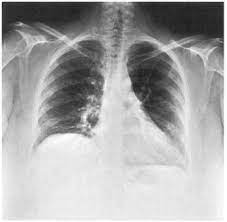 The Shrinking Lungs Syndrome In Systemic Lupus Erythematosus Mayo Clinic Proceedings