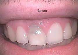 How long do they take? Oasis Dental After Having A Root Canal In This Front Facebook
