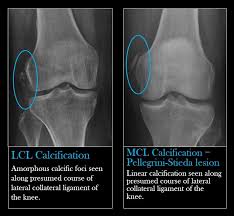 Pin By Mahmoud H Elshenawy On Radio Knee Bone Diseases Disease Anatomy