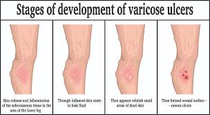Venous Leg Ulcers East Tennessee Vein Clinic
