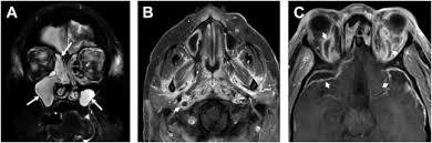 Image result for Intubation Associated Sinusitis