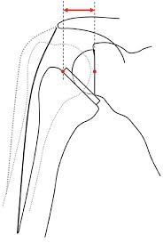 Suprascapular , axillary, subscapular , lateral pectoral and musculocutaneous nerve branches. 1 Schematic Drawing Of A Shoulder Joint Before And After Insertion Of Download Scientific Diagram