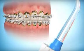 It's pretty easy and useful. Caring For Braces Mol Orthodontics
