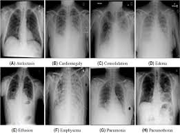 Therefore, knowing the basics and pathologies in the ed setting is very important. Ai Driven Deep Cnn Approach For Multi Label Pathology Classification Using Chest X Rays Peerj