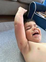 What can I do to help my 2-year-old son's eczema?