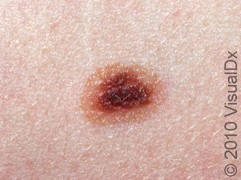 Mole (Nevus) Condition, Treatments and Pictures for Teens - Skinsight