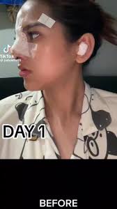 ❗️Silicone to Revision Goretex Rhinoplasty❗️, This patient had silicone  rhinoplasty before from a different surgeon..., Patient concerns:,  ❎️Deviated bridge, ❎️Underprojected tip, ❎️Asymmetry, We had ...