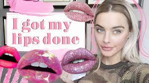So I Got My Lips Done Let S Discuss Lip Wrinkles Lip Fillers Aesthetic Dermatology
