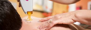 The laser halts all hair follicle growth, leading to the shedding of the hair in the week following treatment. Hair Removal Lasers New Freedom Laser