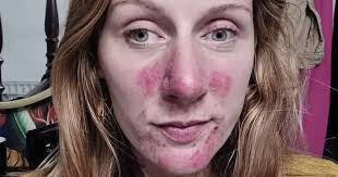 Woman whose face was plagued with weeping sores now has clear skin thanks  to 'miracle' cream