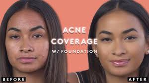 foundation tutorial for covering acne