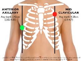 Image result for Small Caliber Chest Tube
