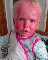 Girl, 2, has such bad psoriasis she 'looks like a little crab' and  strangers ask if she's contagious