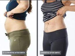Postnatal Before After Diastasis Recti Repair Diastasis Recti Diastasis Recti Exercises