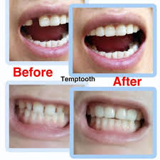Jangka waktu sebentar ini tergantung gigi yang rusak biasa, parah atau sangat parah. Temptooth Gigi Palsu Diy Temporary Tooth Shopee Malaysia